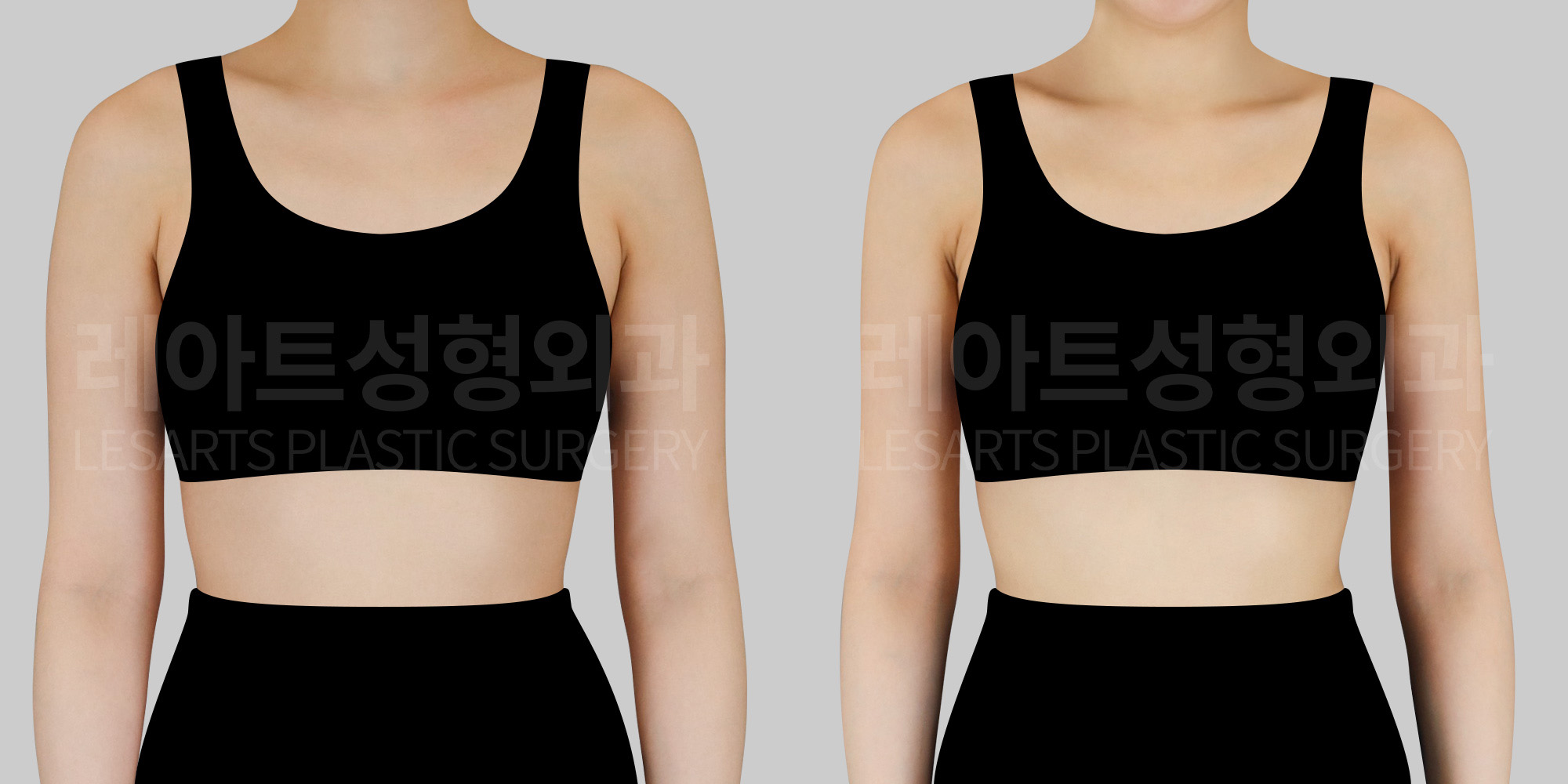 arm liposuction before and after(front)-lesarts plastic surgery