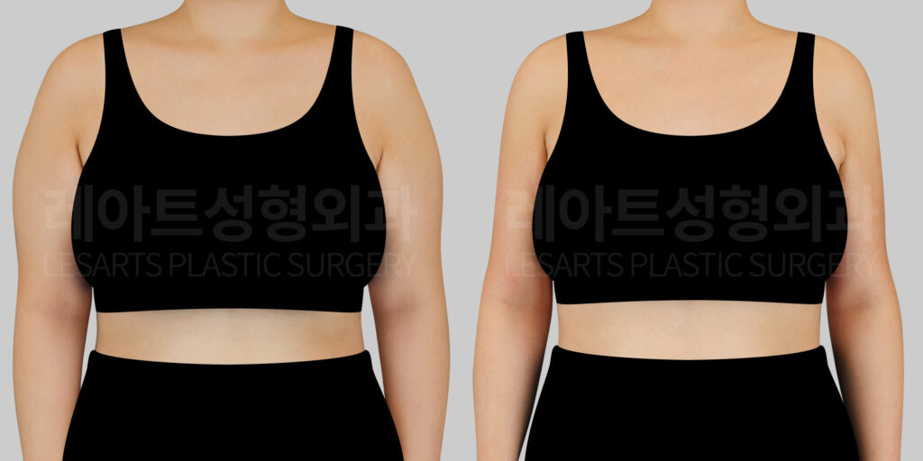 lesarts arm liposuction before and after