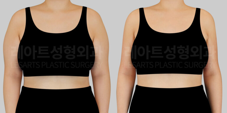 lesarts arm liposuction before and after