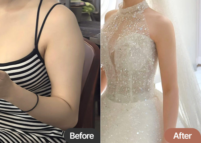 arm-liposuction-thumbnail-UnniU3jhl5