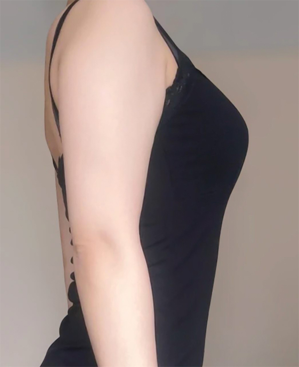 arm-liposuction-thumbnail-chugumijangwonyoung-before