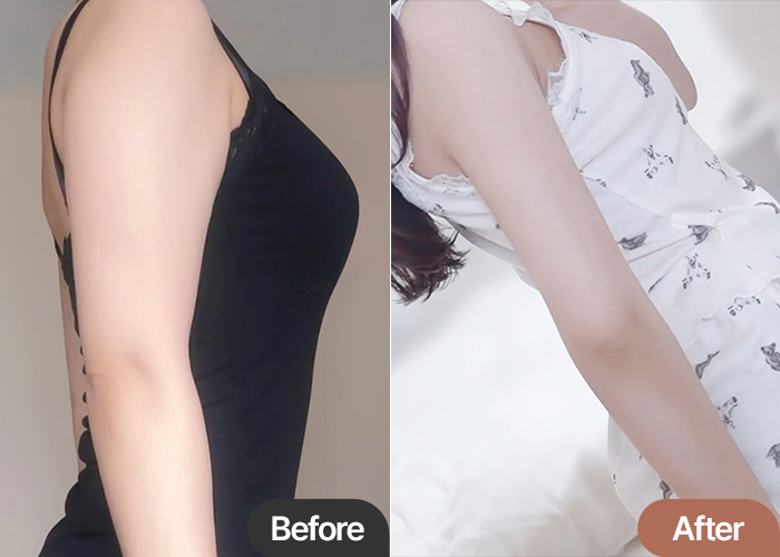 Arm Liposuction in Korea Before & After – Slimmer Arms, Better Proportions