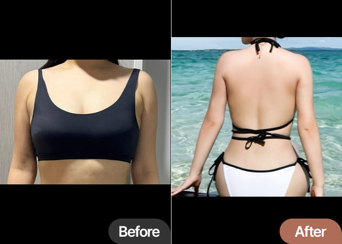 Bra Line & Arm Liposuction in Korea Before & After – Confident Swimwear Results