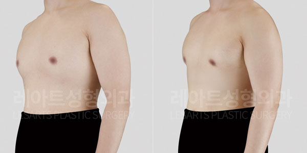 lesarts gynecomastia before and after
