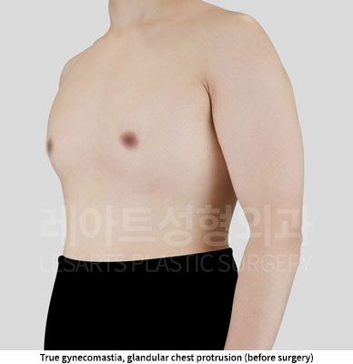 gynecomastia-02-01-251128