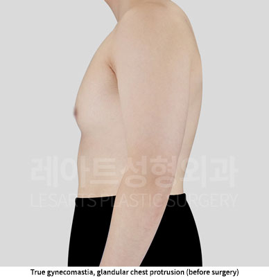 gynecomastia-02-02-251128
