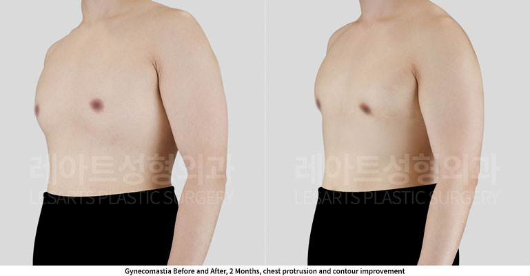 gynecomastia-02-03-251128