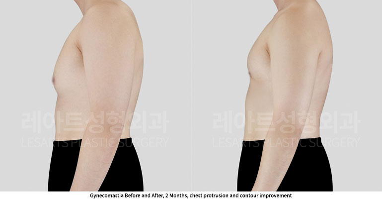 gynecomastia-02-04-251128