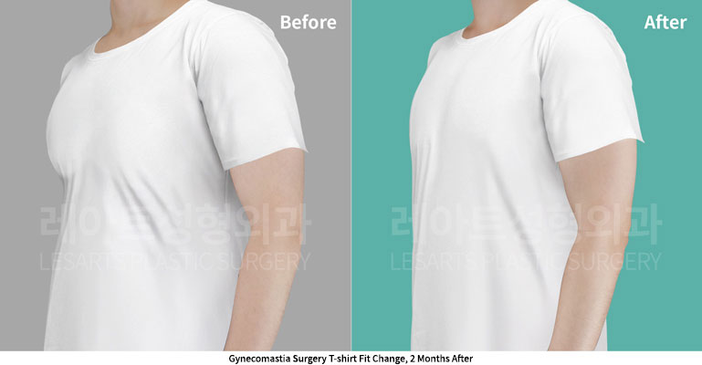gynecomastia-02-05-251128