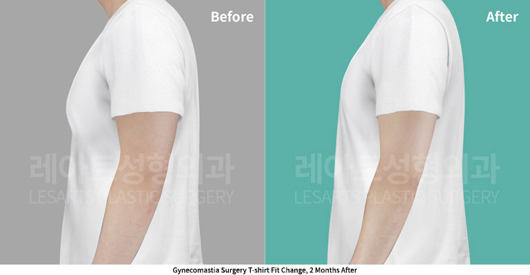 gynecomastia-02-06-251128