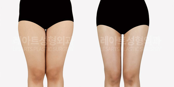 thigh liposuction before and after-lesarts plastic surgery