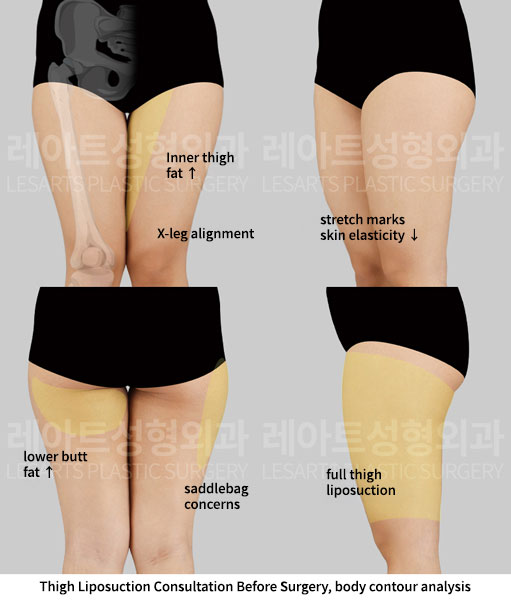 thigh-liposuction-02-01-251201