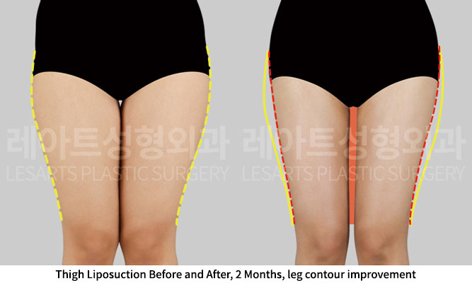 thigh-liposuction-02-02-251201