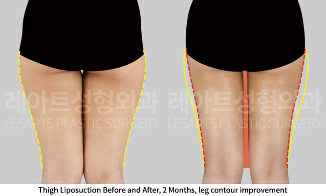 thigh-liposuction-02-03-251201
