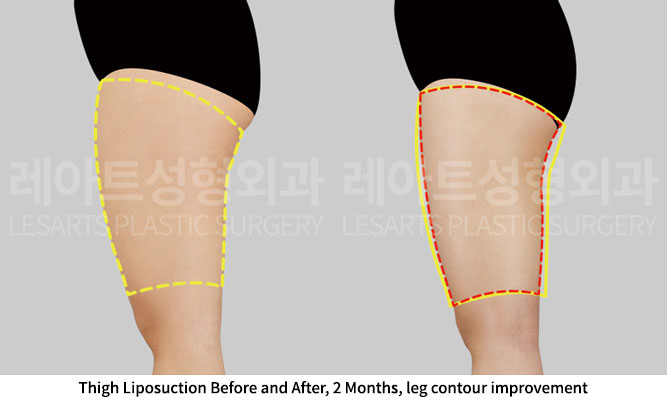 thigh-liposuction-02-04-251201
