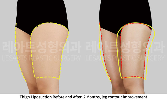 thigh-liposuction-02-05-251201