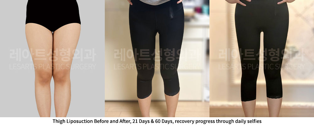 thigh-liposuction-02-06-251201