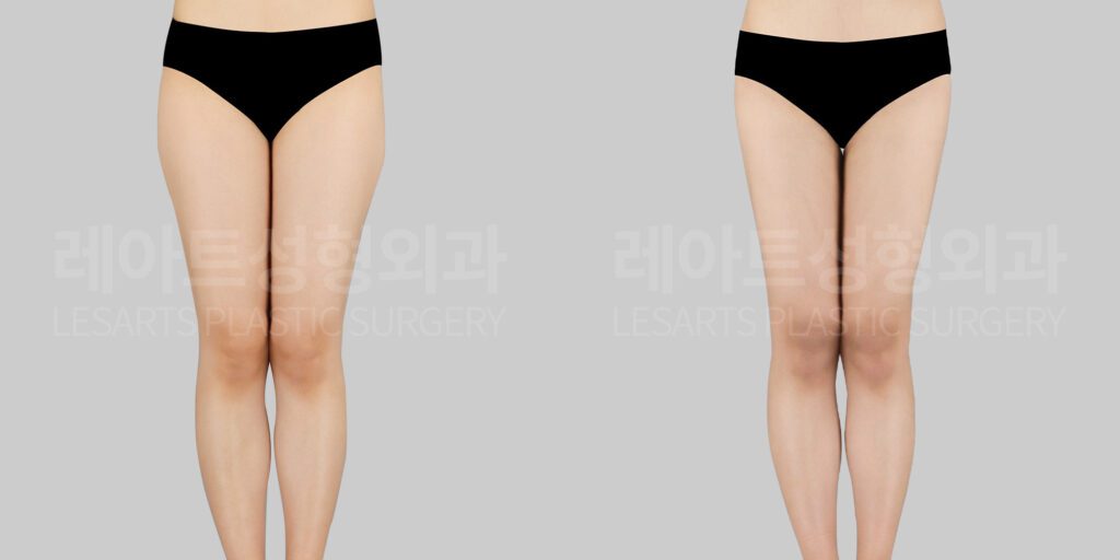 thigh liposuction before and after-lesarts plastic surgery