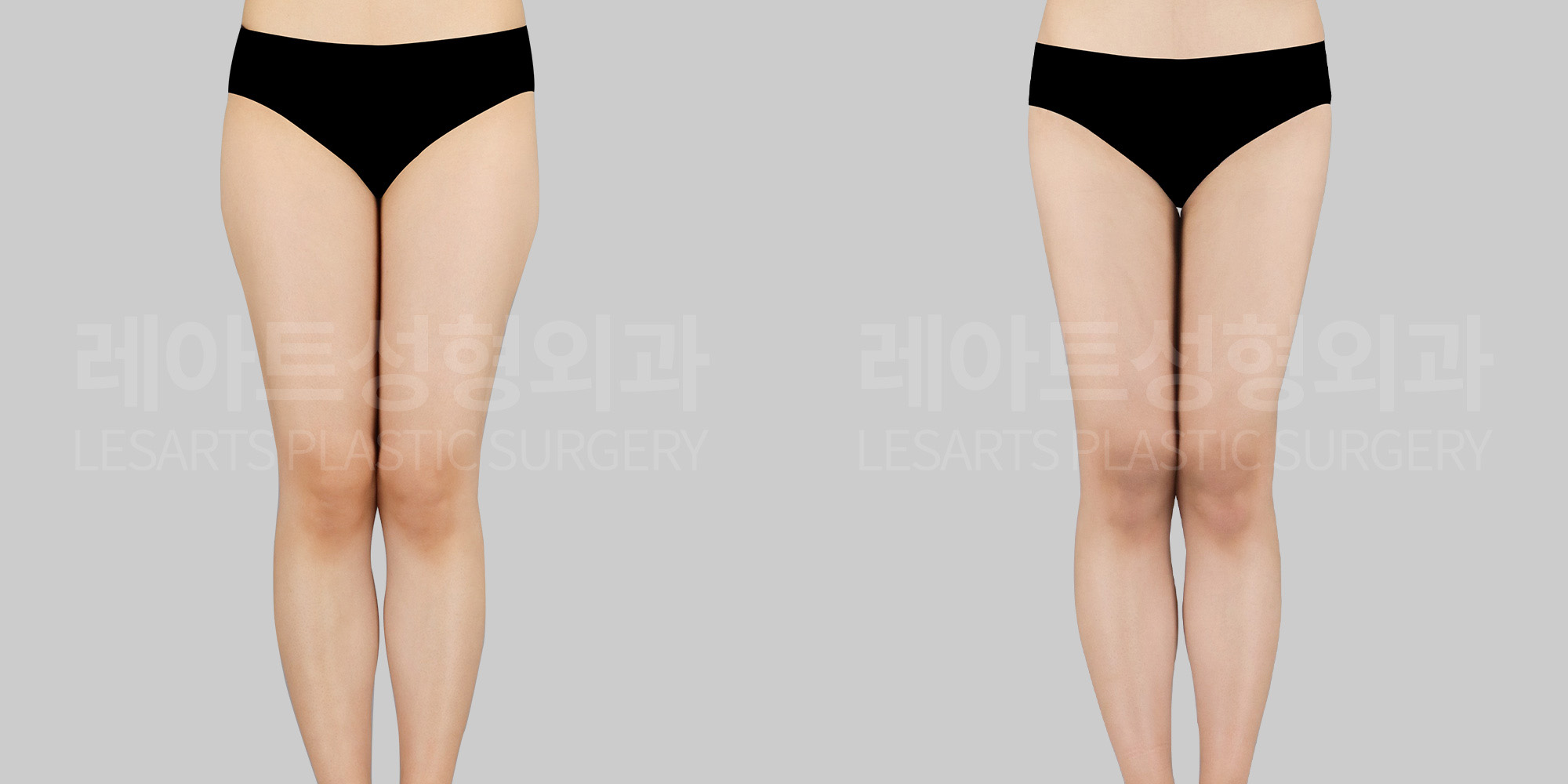 thigh liposuction before and after-lesarts plastic surgery
