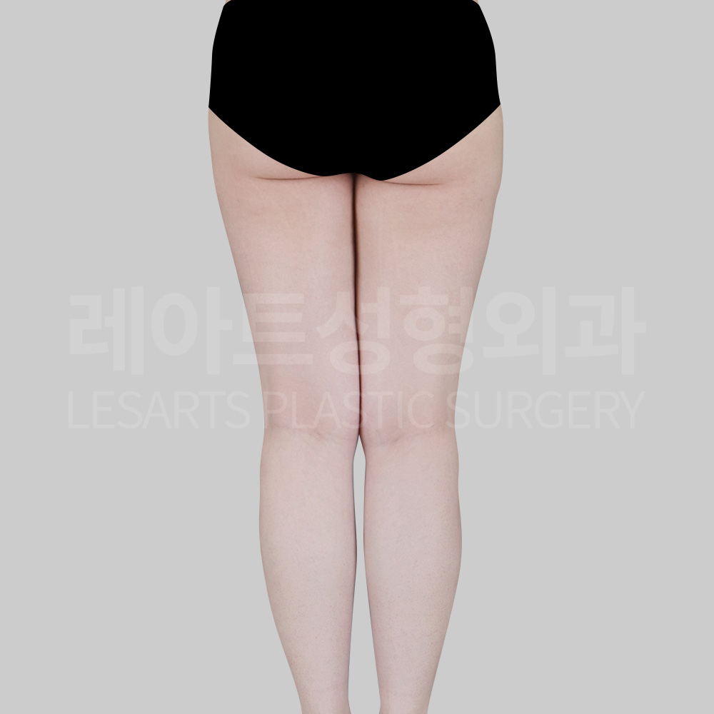 thigh-liposuction-30783-before-back
