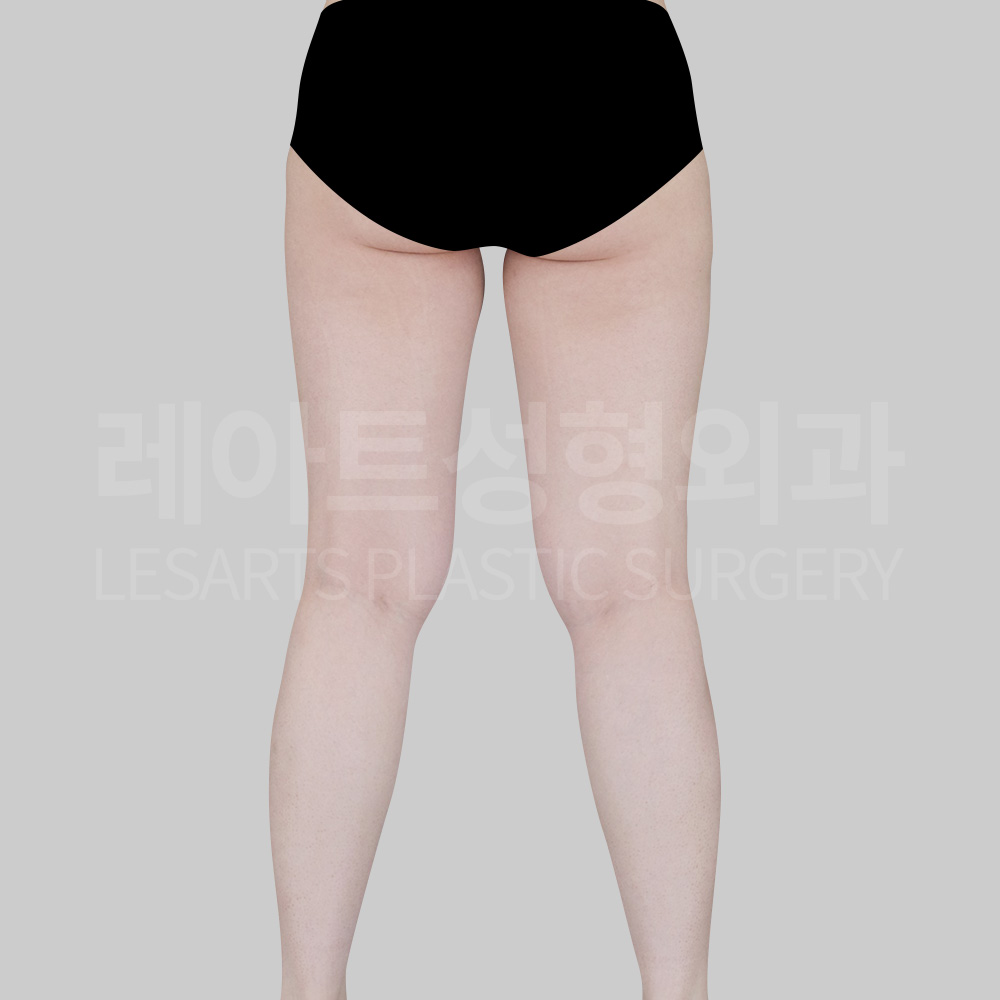 thigh-liposuction-30783-before-back2