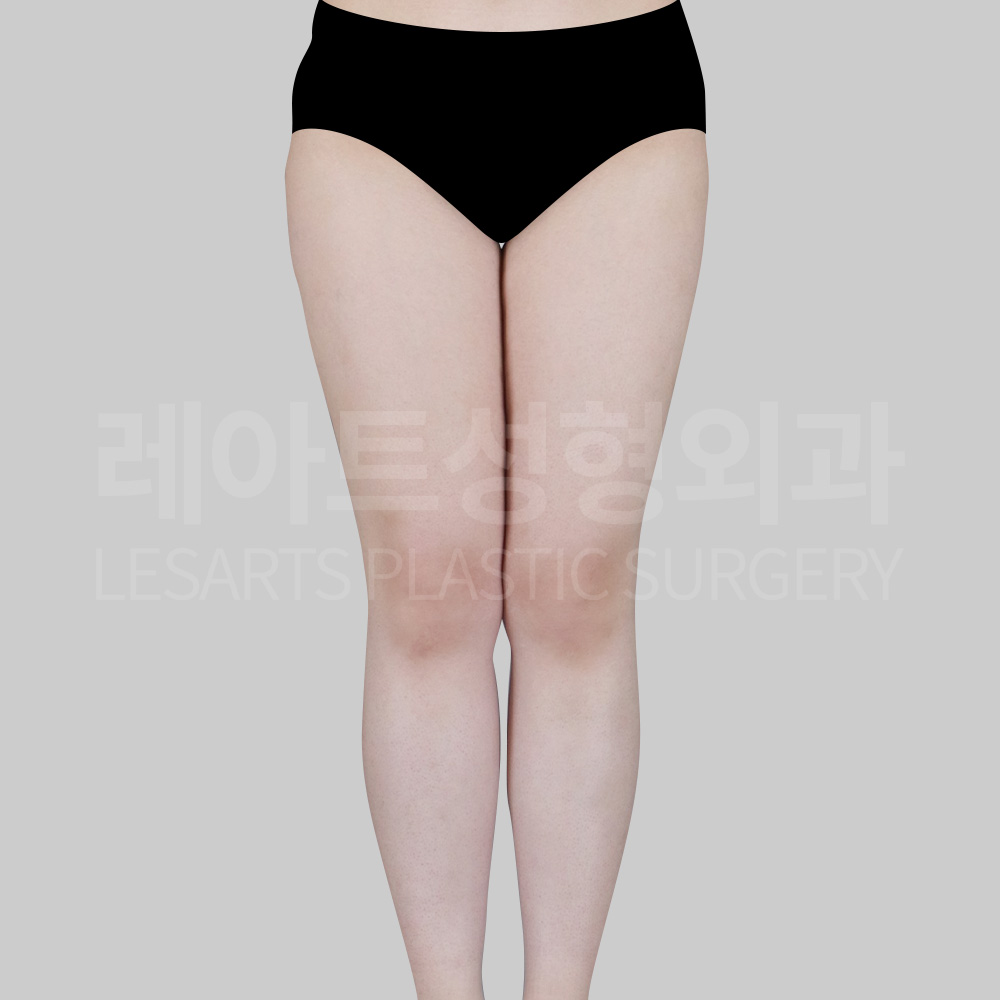 thigh-liposuction-30783-before-frnont