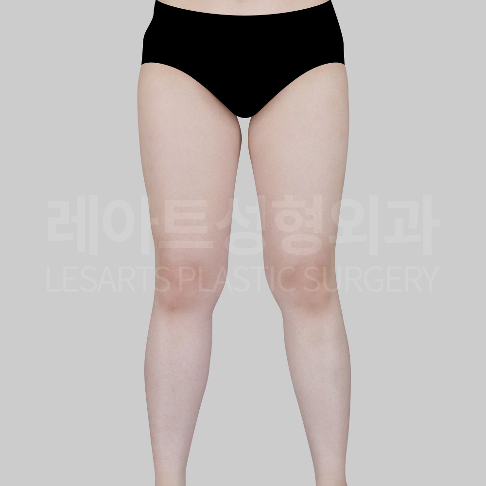 thigh-liposuction-30783-before-front2