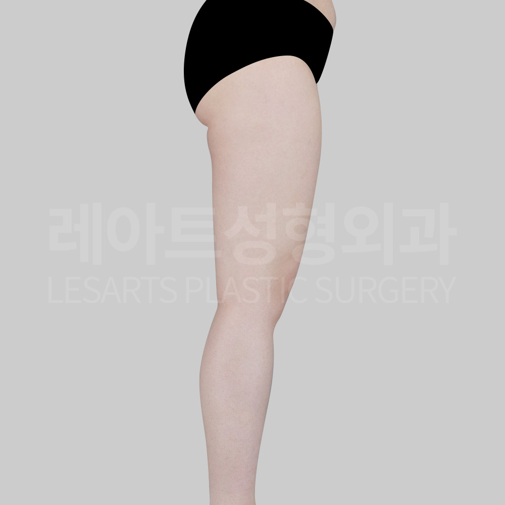 thigh-liposuction-30783-before-right-side