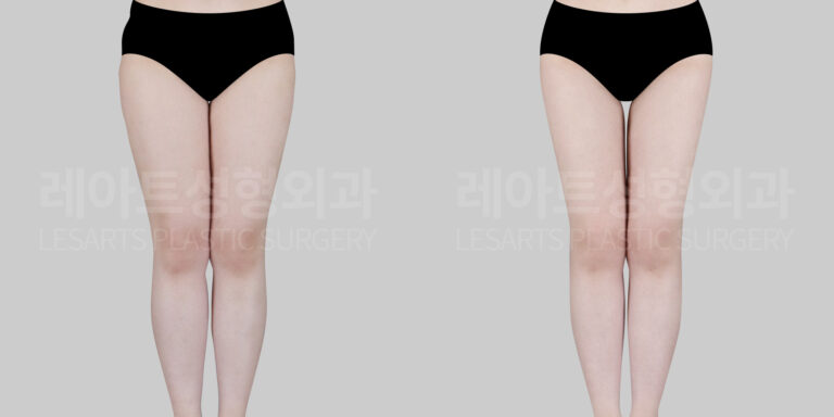 thigh liposuction before and after