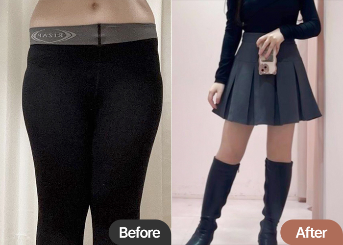 thigh-liposuction-thumbnail-Bangpaemak