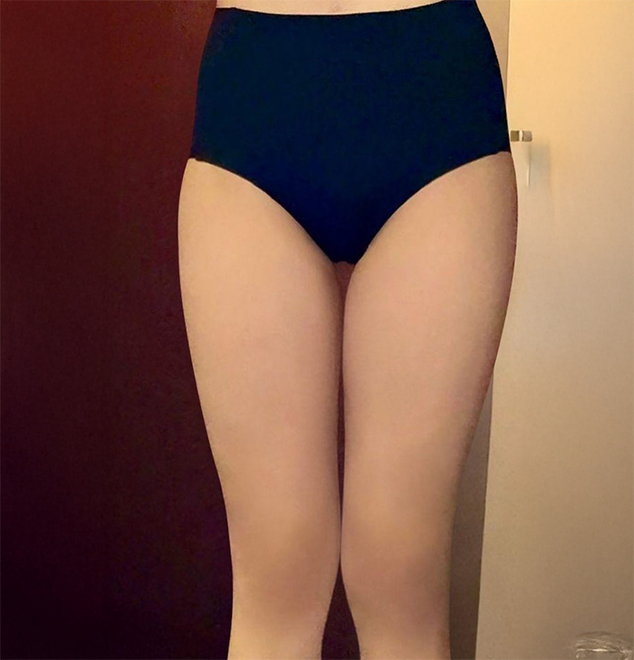 thigh-liposuction-thumbnail-Daejibuji-before