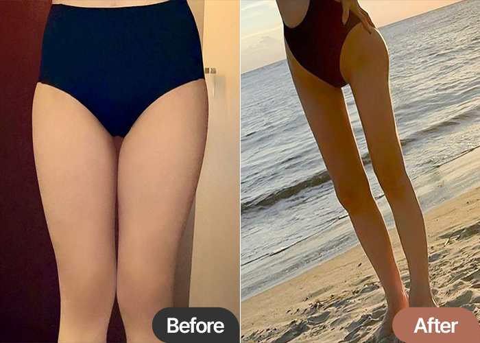 thigh-liposuction-thumbnail-Daejibuji
