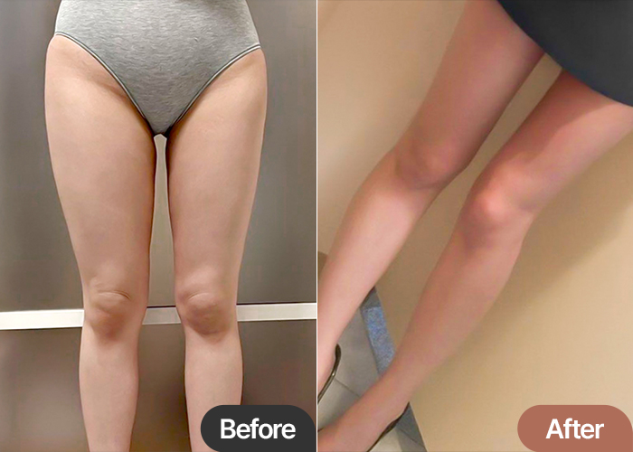 thigh-liposuction-thumbnail-Hyeoeonga