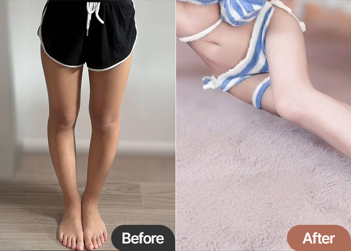 thigh-liposuction-thumbnail-Jellypporing