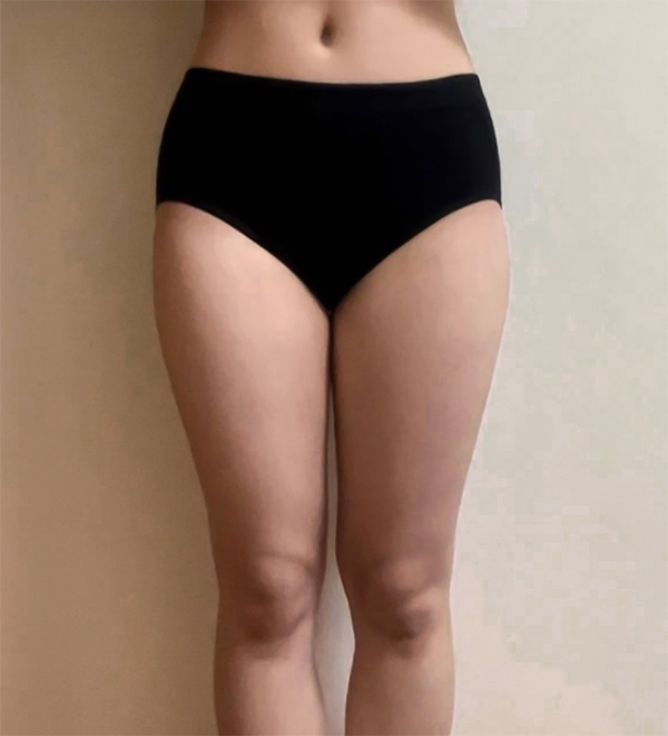 thigh-liposuction-thumbnail-Omyujjuju-before