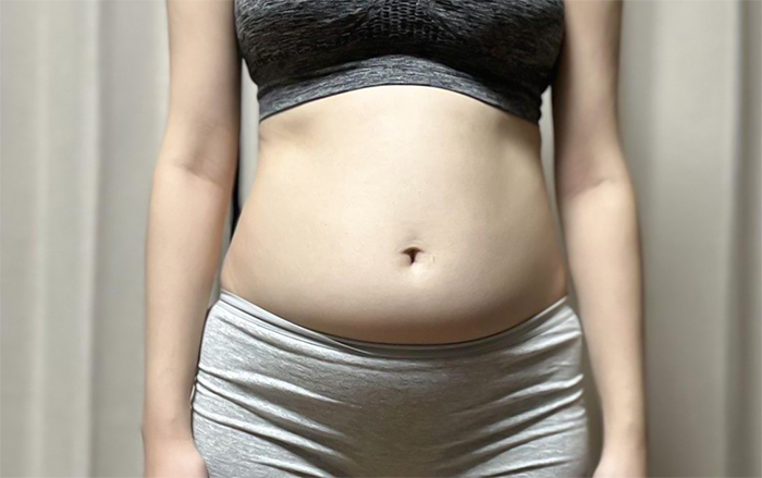 thigh-liposuction-thumbnail-Tensionoreumi-before