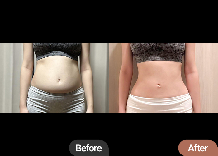thigh-liposuction-thumbnail-Tensionoreumi