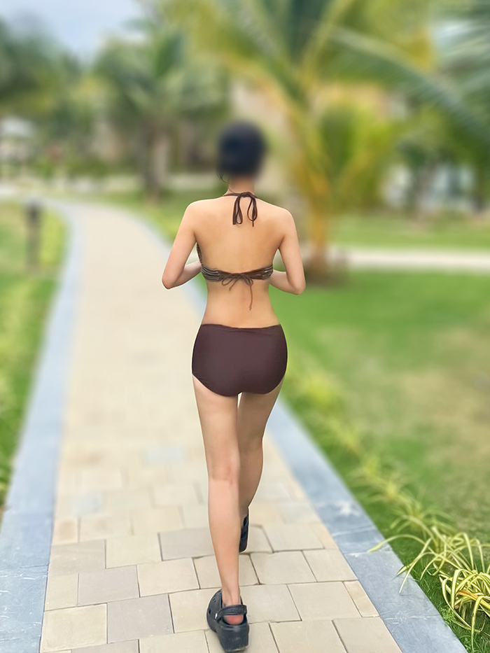 thigh-liposuction-thumbnail-minjiyuan-after