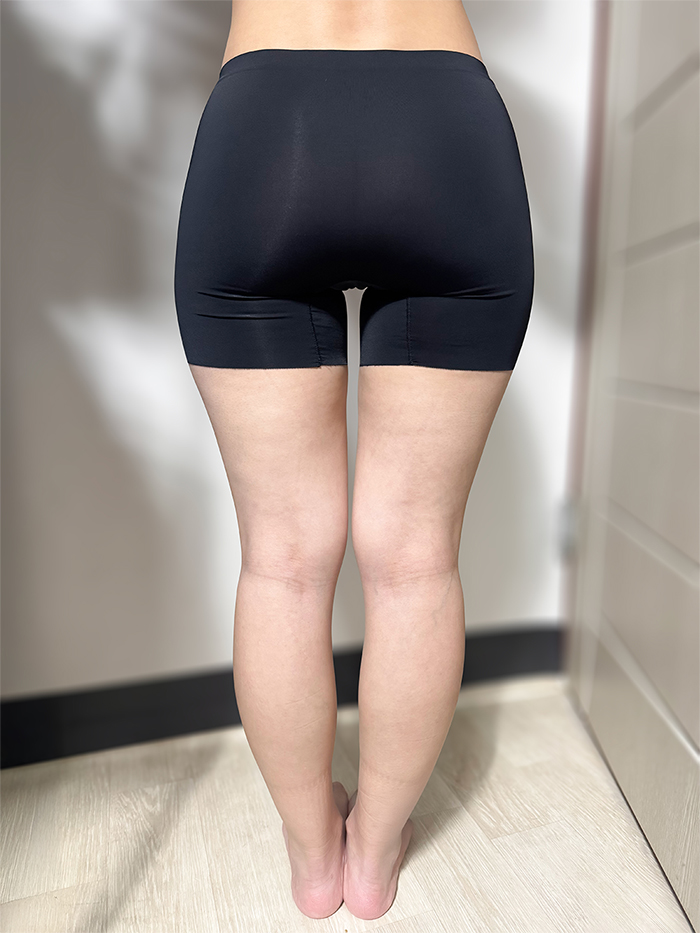thigh-liposuction-thumbnail-minjiyuan-before