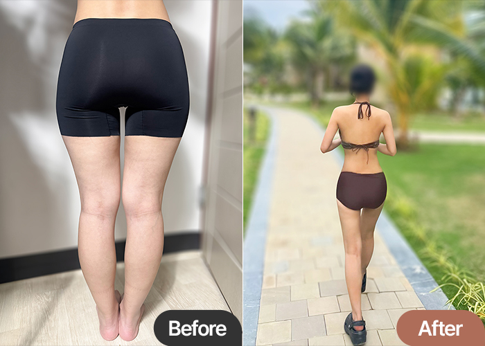 thigh-liposuction-thumbnail-minjiyuan