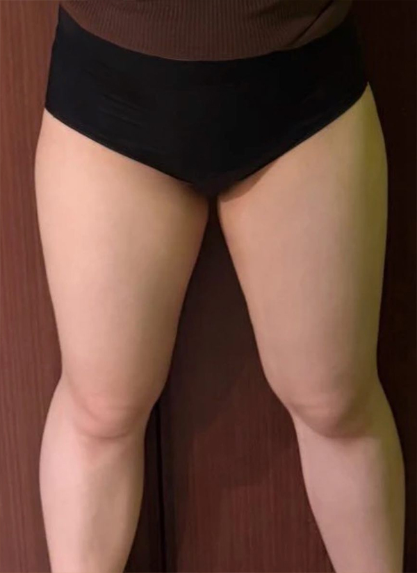thigh-liposuction-thumbnail-rulluhayeo-before