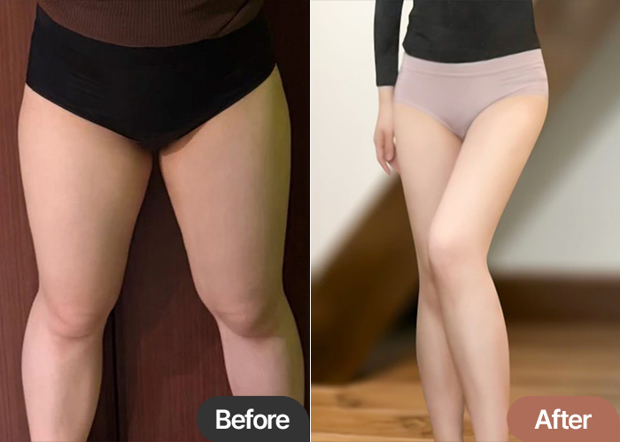 thigh-liposuction-thumbnail-rulluhayeo