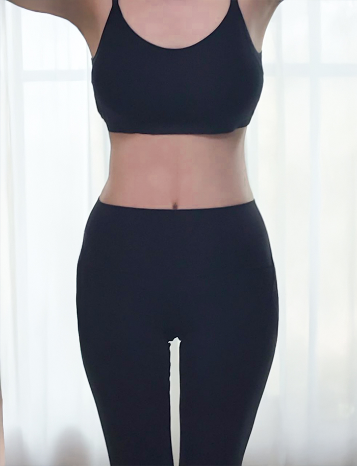 tummy-tuck-thumbnail-7nniKvp7ol-after