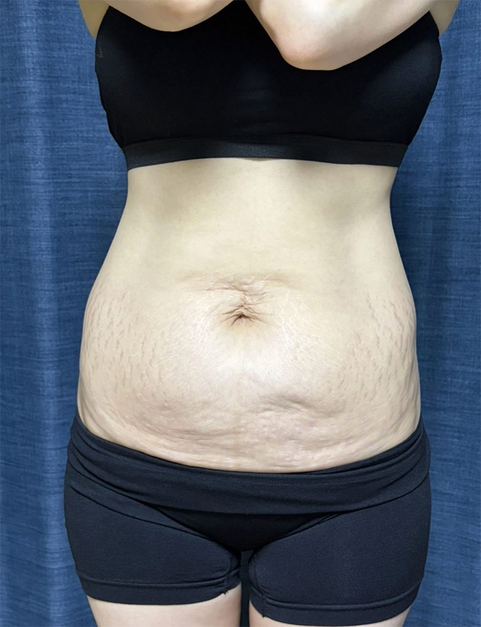 tummy-tuck-thumbnail-7nniKvp7ol-before