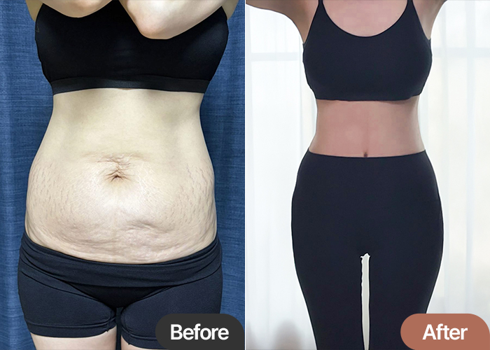 Tummy Tuck & Abdominal Liposuction in Korea Before & After – Postpartum Transformation
