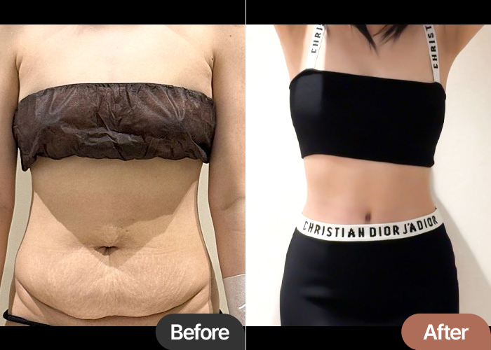 Tummy Tuck in Korea Before & After – Sagging Belly Transformation Success