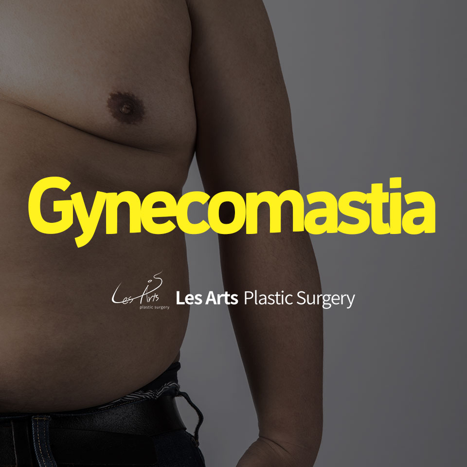 [Gynecomastia]Men with Gynecomastia Who Fear Summer — The Season They Can’t Stand with Confidence