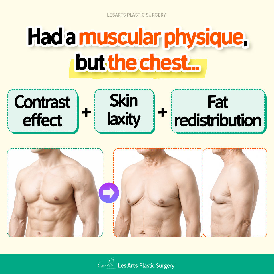 [Gynecomastia] “Does Stopping Exercise Cause Gynecomastia?” — Chest Changes in Middle-Aged Men: Gynecomastia or Simple Fat Gain?