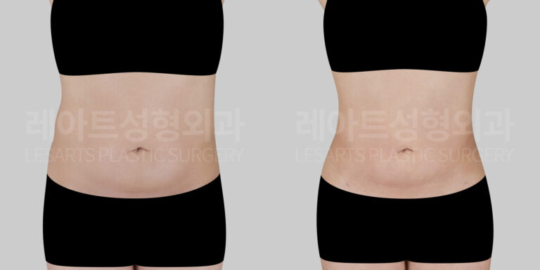 lesarts abdominal liposuction before & after comparison
