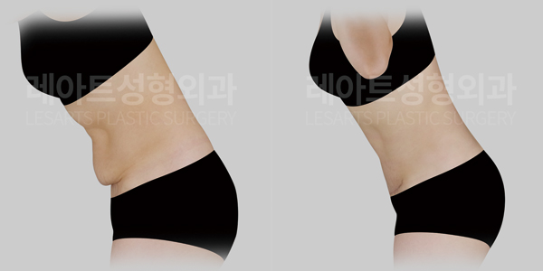 abdominoplasty before and after